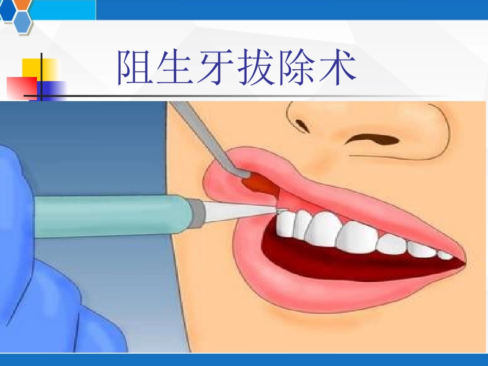 阻生牙拔除术PPT培训课件_第1页