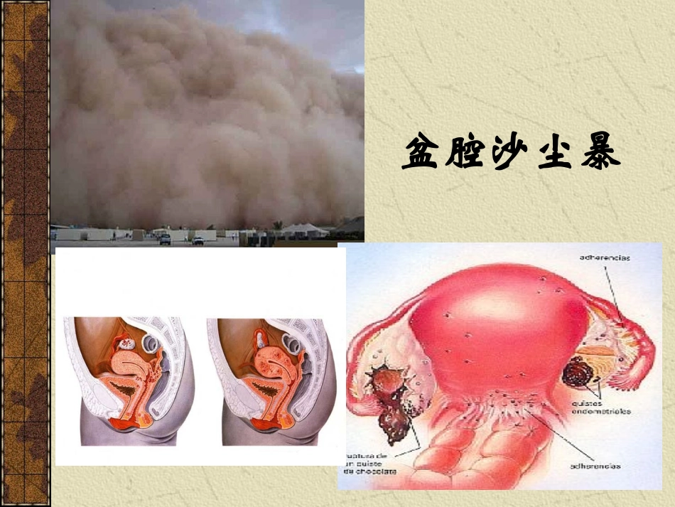 子宫内膜异位症PPT培训课件_第1页