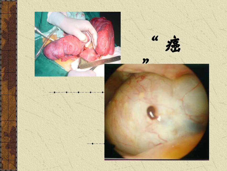 子宫内膜异位症PPT培训课件_第2页