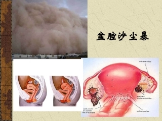 子宫内膜异位症PPT培训课件