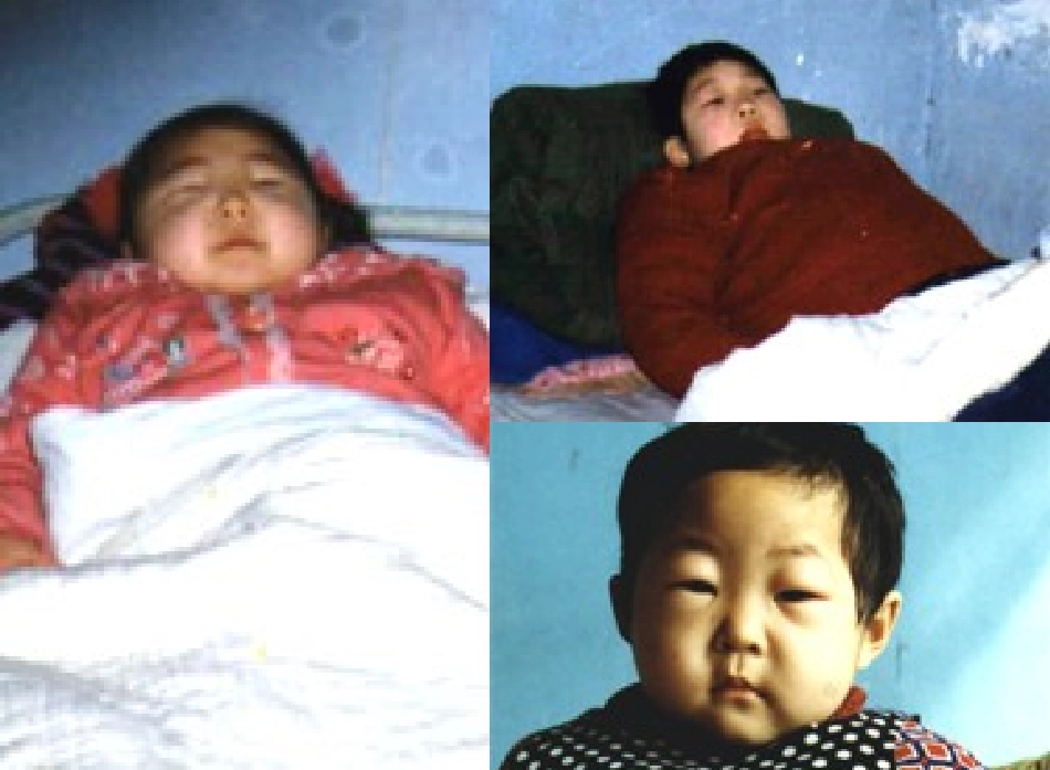 中医内科学水肿PPT培训课件_第3页