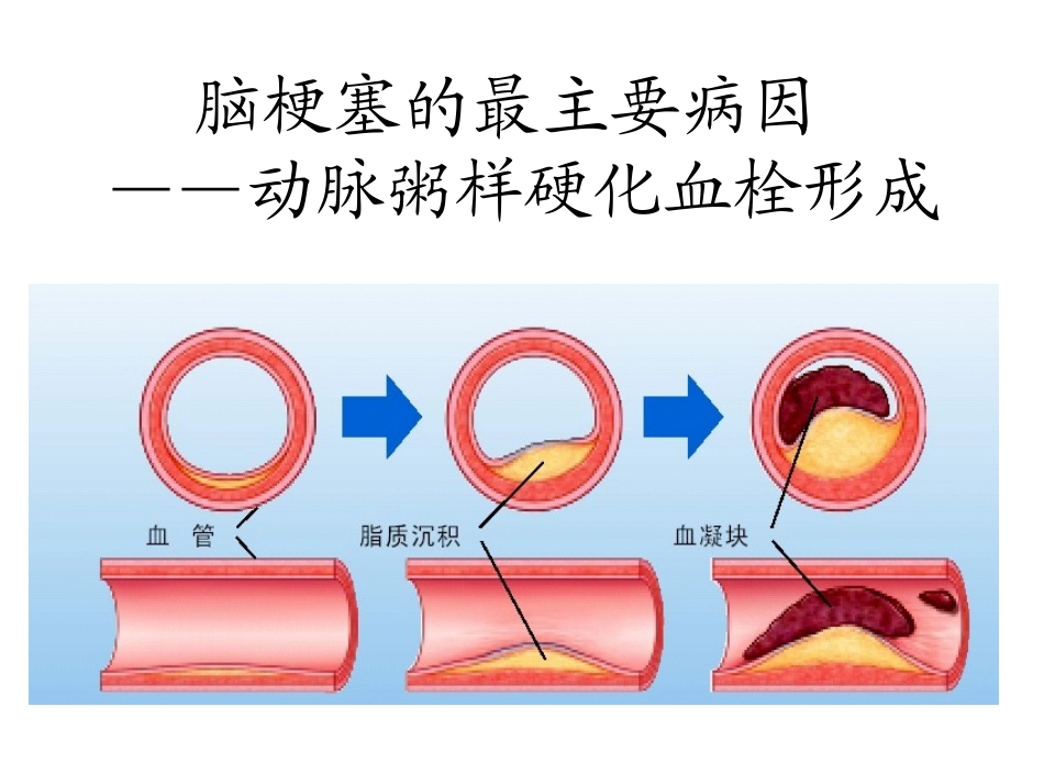 中风病护理查房PPT培训课件_第2页