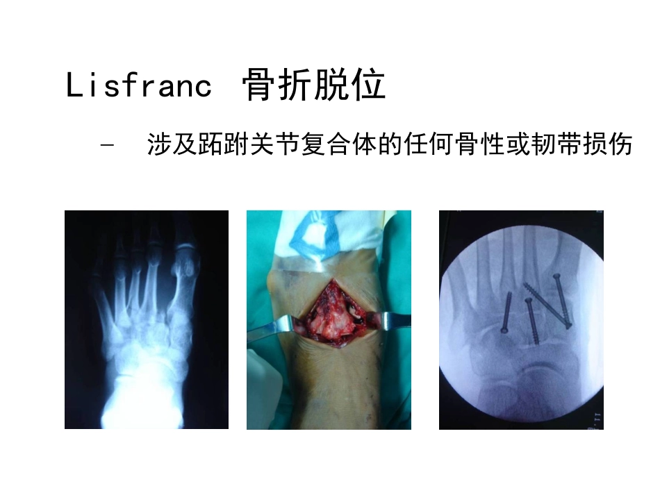 跖跗关节损伤PPT培训课件_第3页