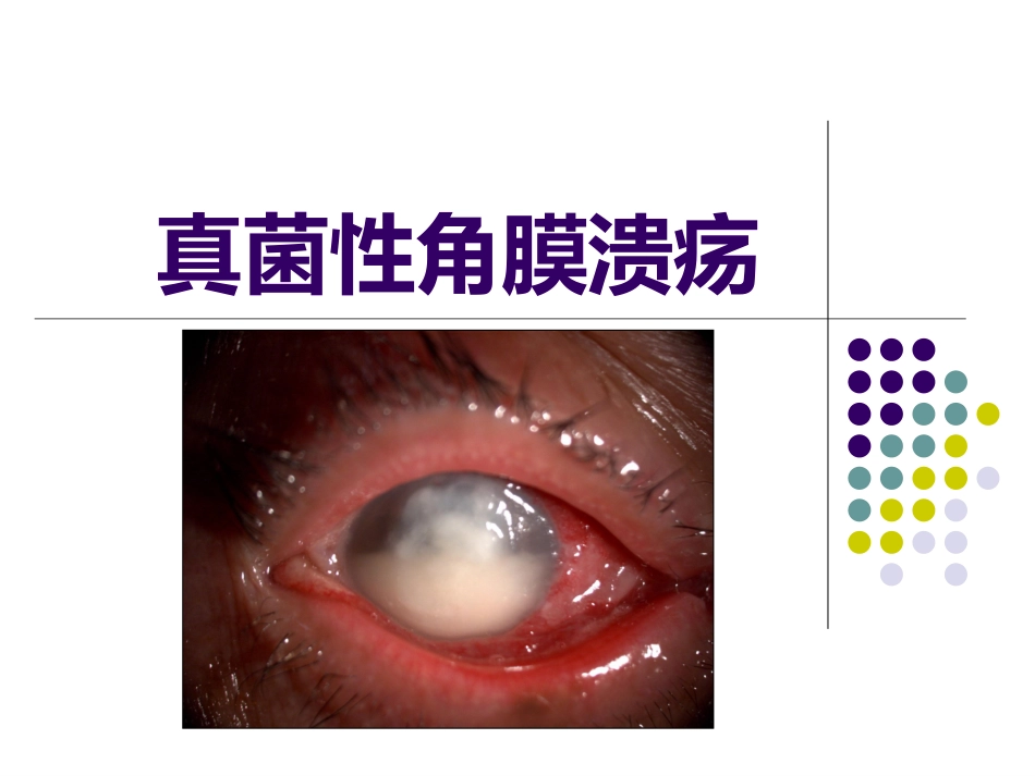 真菌性角膜炎PPT培训课件_第1页