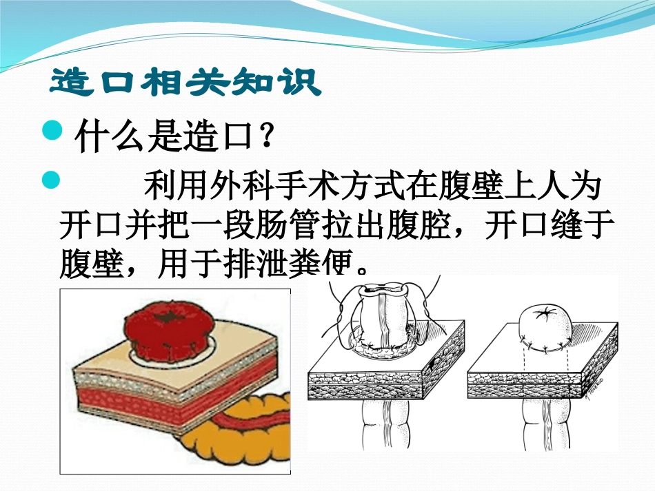 造口护理查房PPT培训课件_第2页