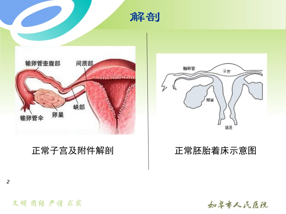 异位妊娠讲义PPT培训课件_第2页