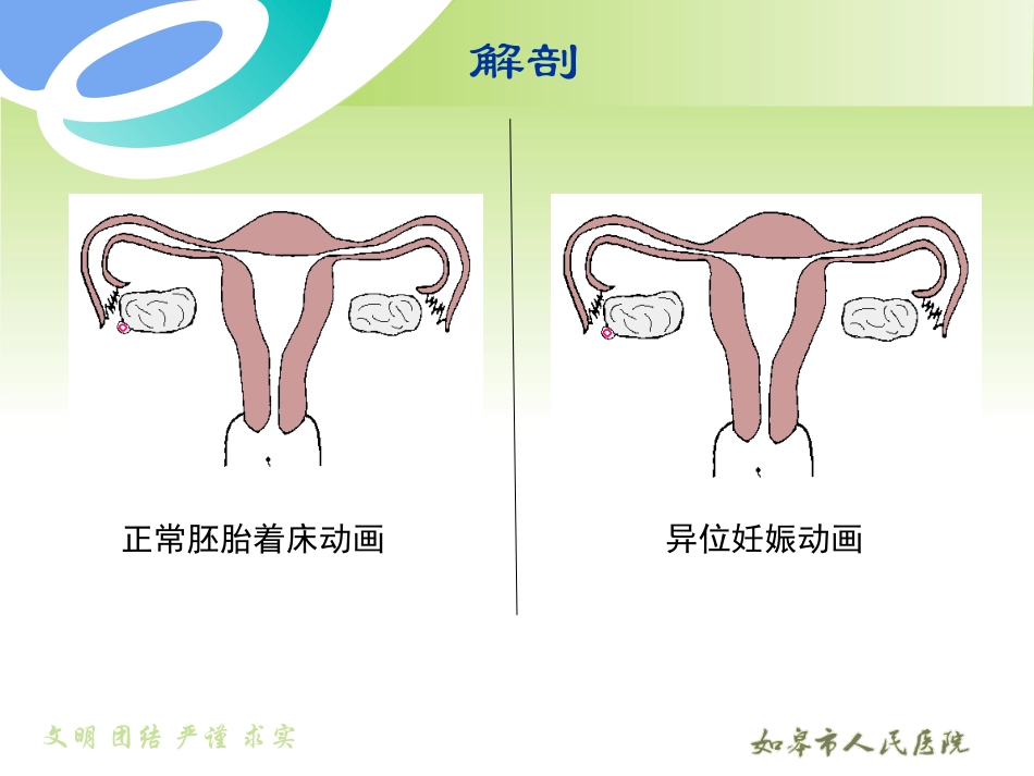 异位妊娠讲义PPT培训课件_第3页