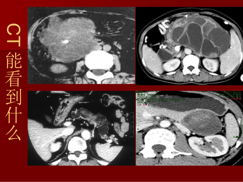 胰腺囊性肿瘤PPT培训课件_第2页