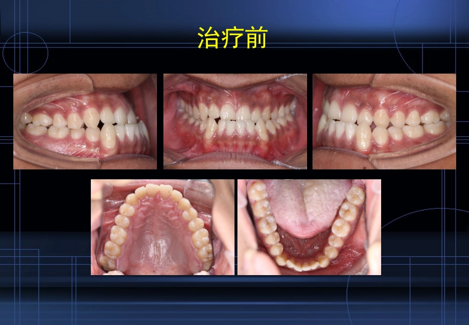 牙齿矫正保持PPT培训课件_第3页