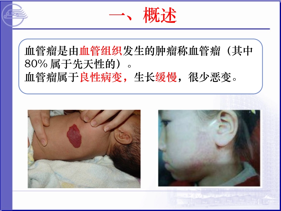 血管瘤的护理PPT培训课件_第2页