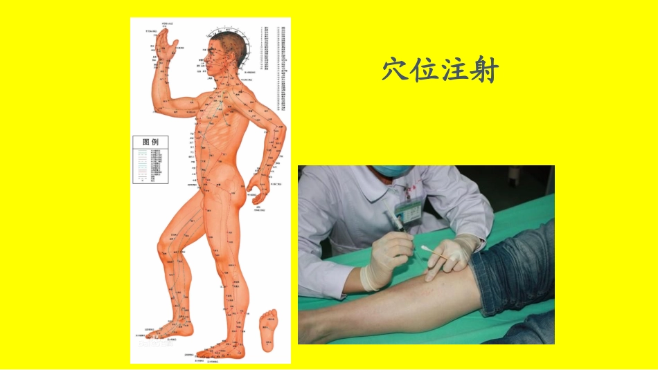穴位注射水针PPT培训课件_第3页