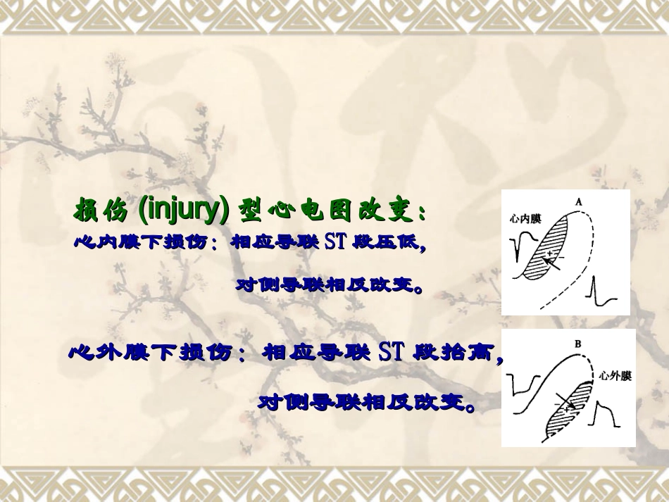 心肌缺血心电图PPT培训课件_第2页