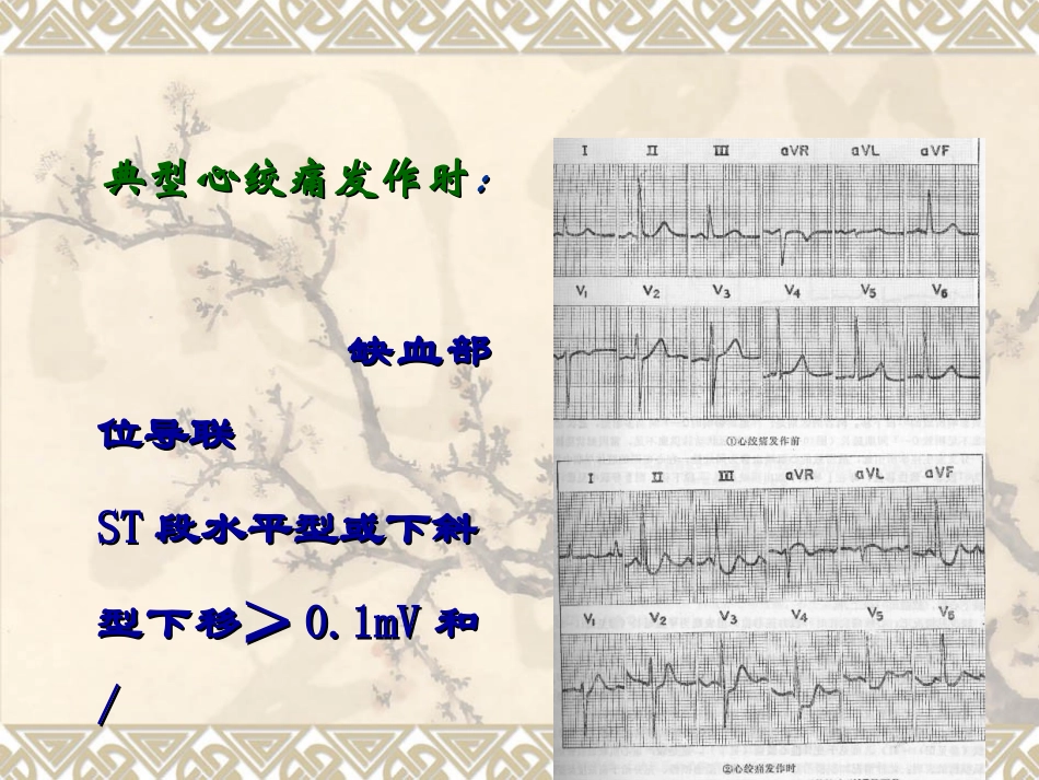 心肌缺血心电图PPT培训课件_第3页