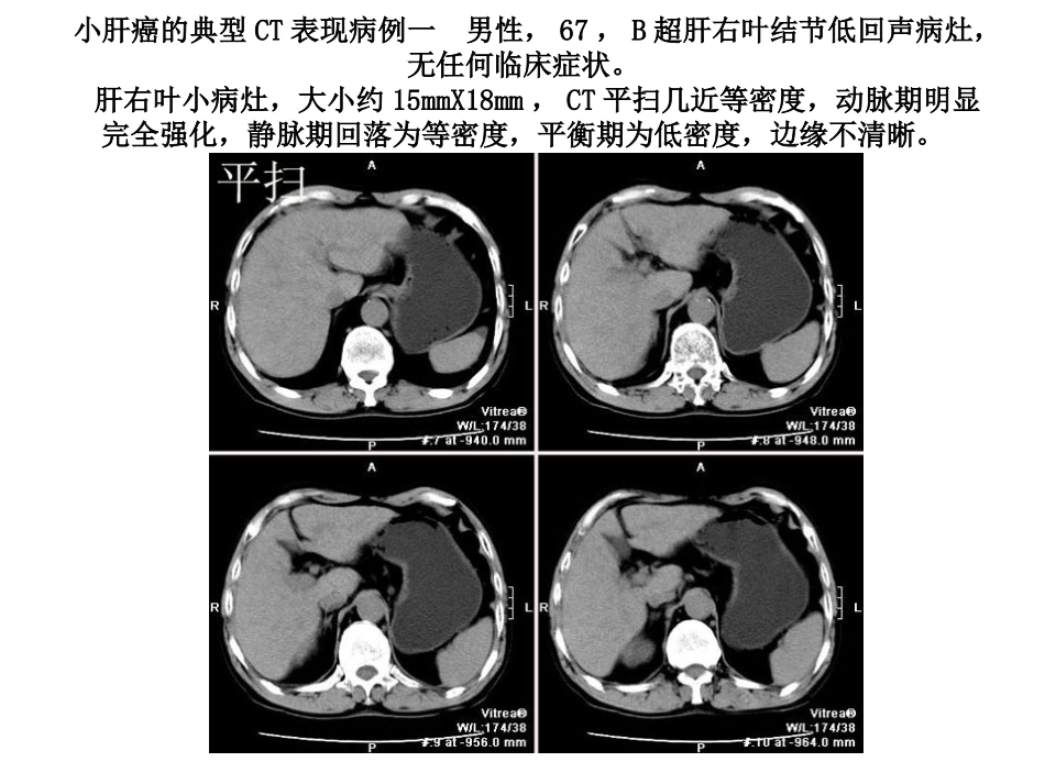小肝癌的ct表现PPT培训课件_第2页