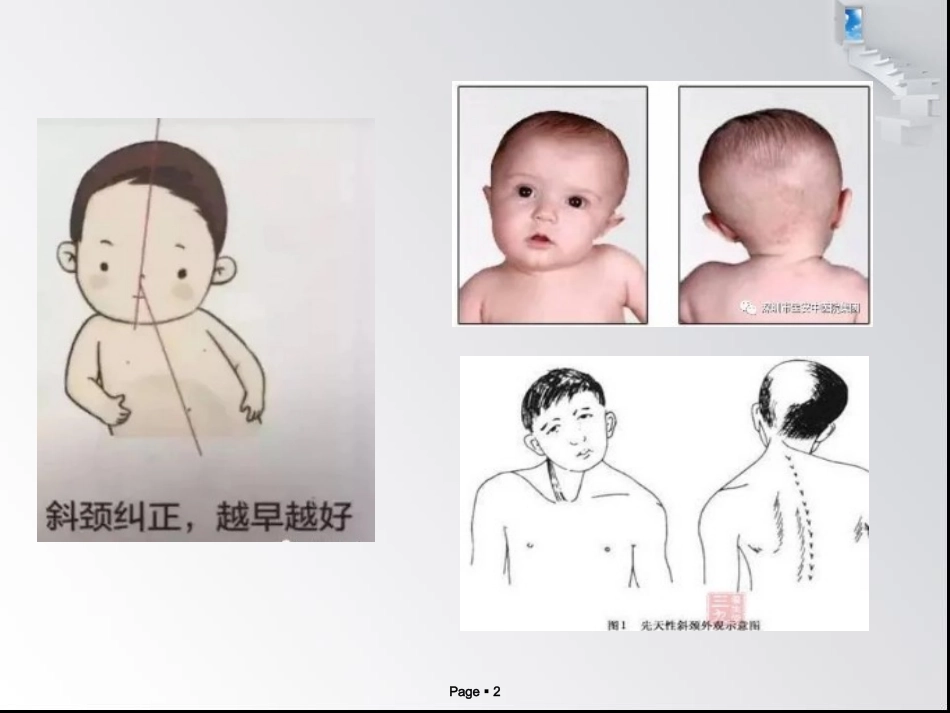 小儿肌性斜颈PPT培训课件_第2页