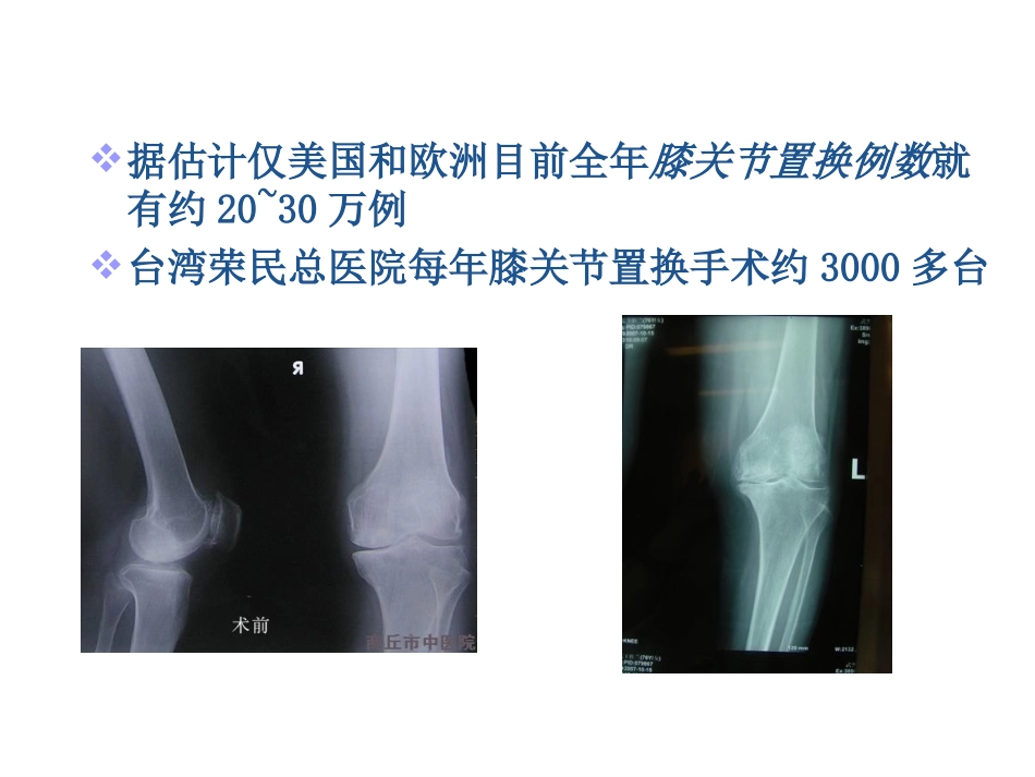 膝关节置换术PPT培训课件_第2页