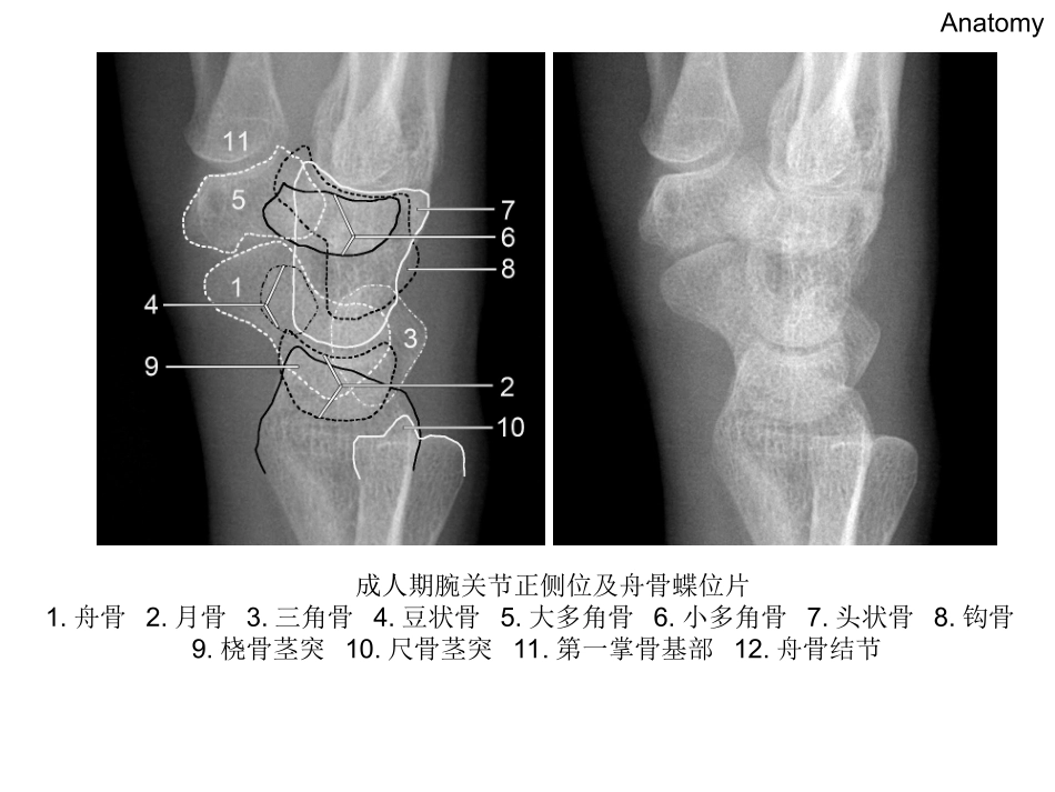 腕关节X线解剖PPT培训课件_第3页