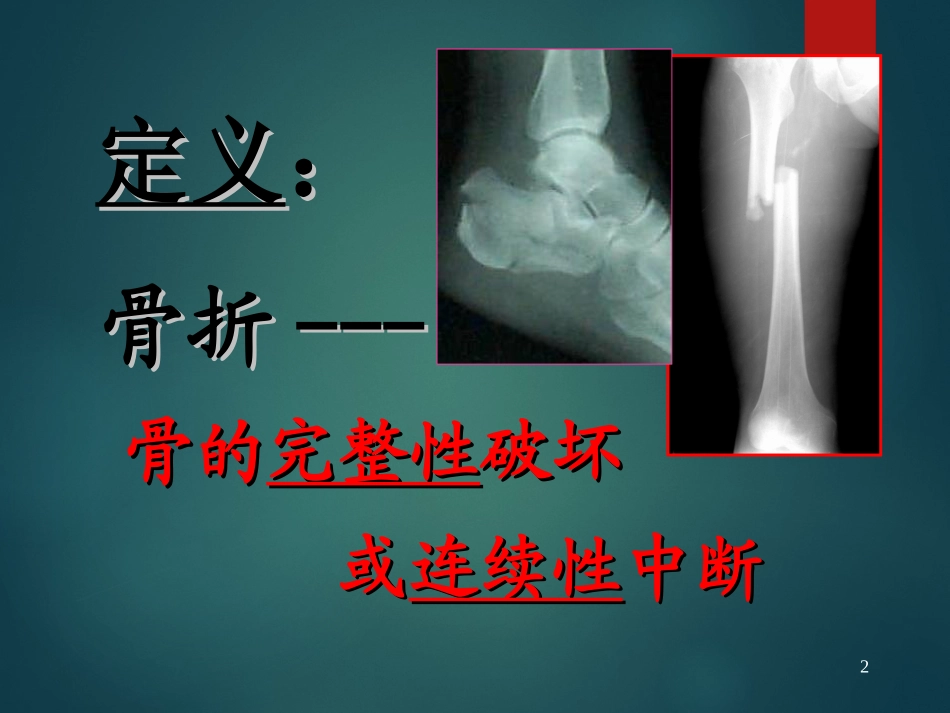 外科学骨折概论PPT培训课件_第2页