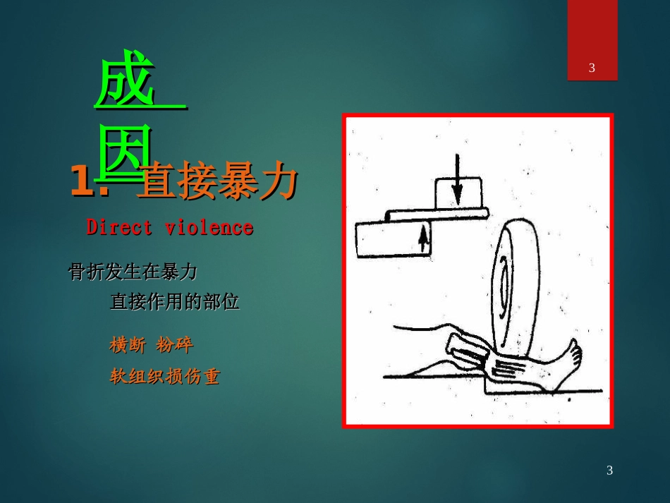 外科学骨折概论PPT培训课件_第3页