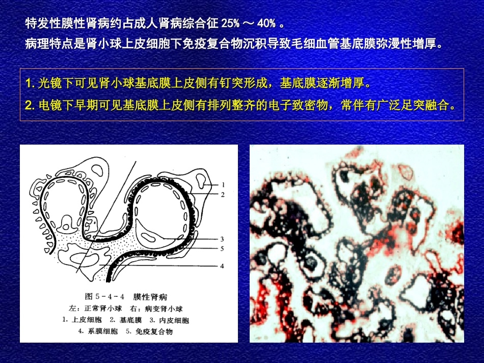特发性膜性肾病PPT培训课件_第2页