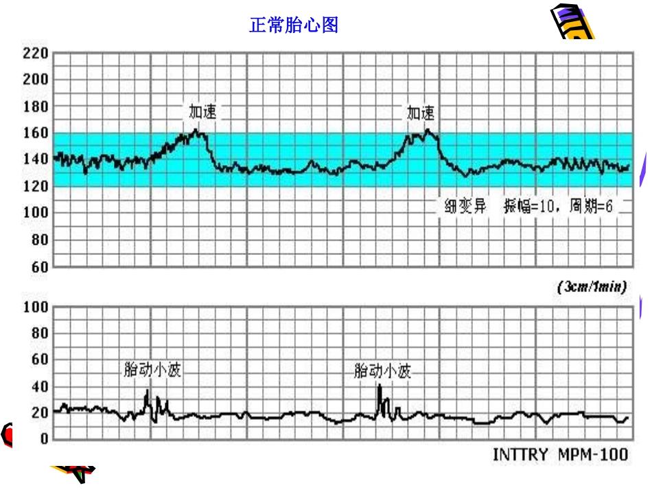 胎心监护资料PPT培训课件_第3页