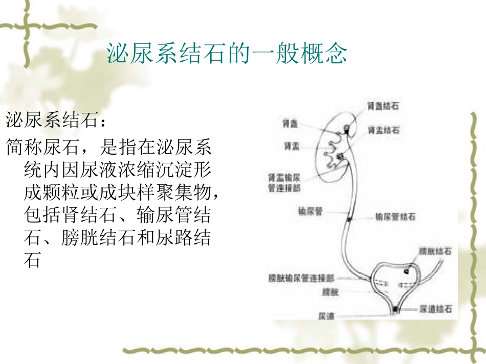 肾结石护理查房PPT培训课件_第3页