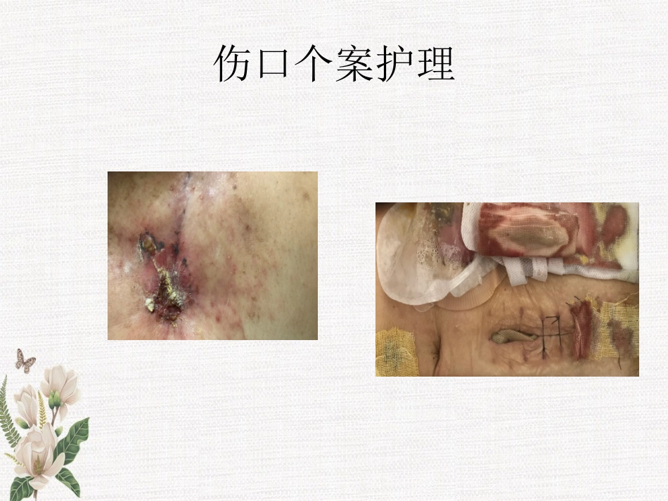 伤口个案护理PPT培训课件_第1页