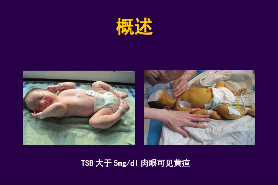 浅谈新生儿黄疸PPT培训课件_第3页