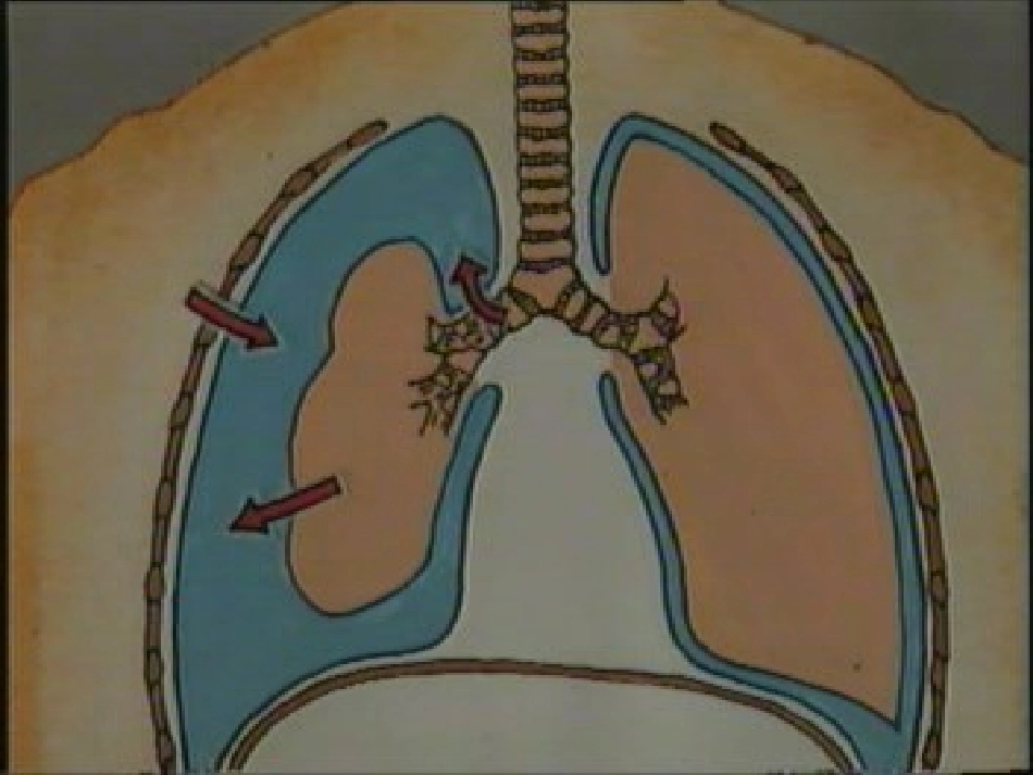 气胸急诊处理PPT培训课件_第3页