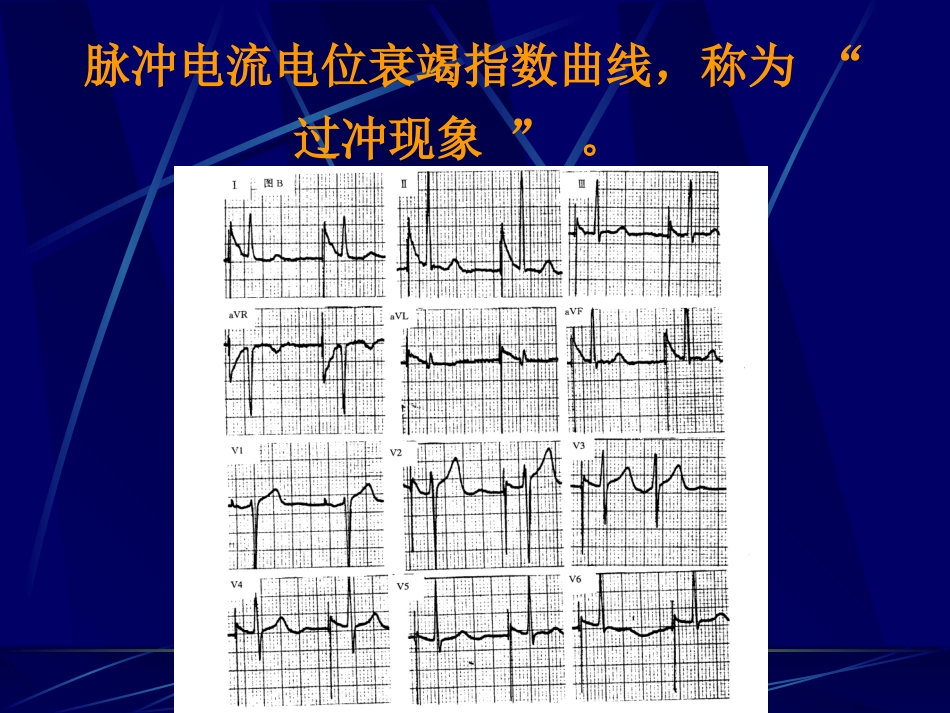 起搏心电图分析PPT培训课件_第3页