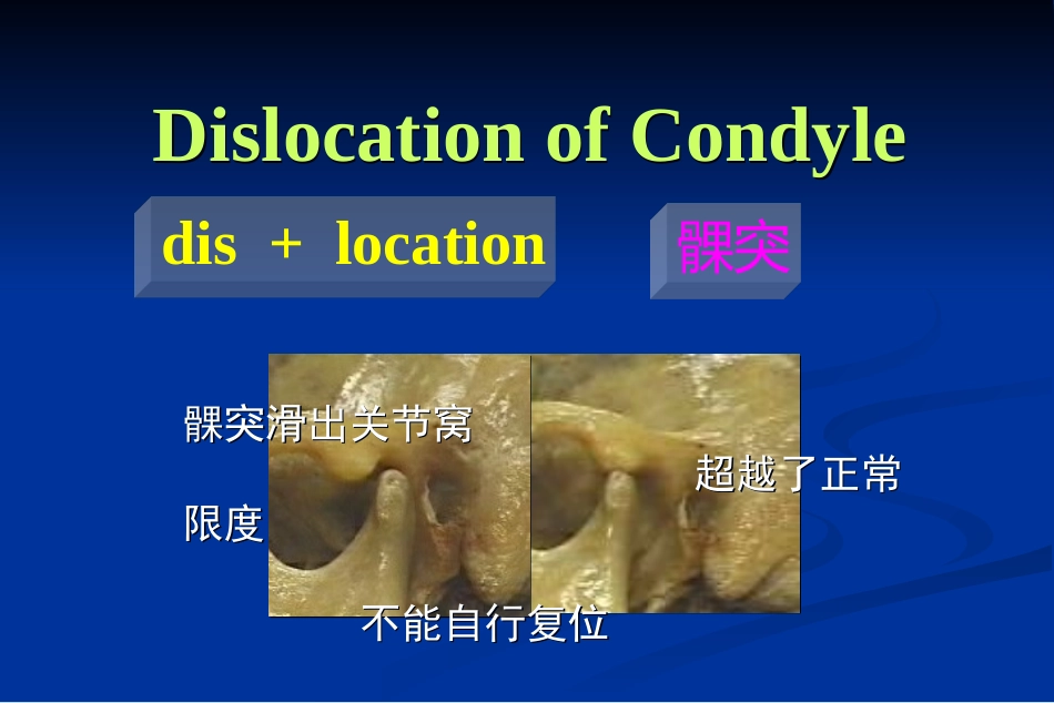 颞下颌关节脱位PPT培训课件_第2页