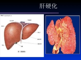 内科学肝硬化PPT培训课件