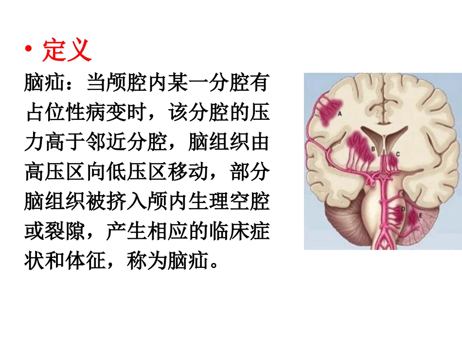 脑疝病人的护理PPT培训课件_第2页