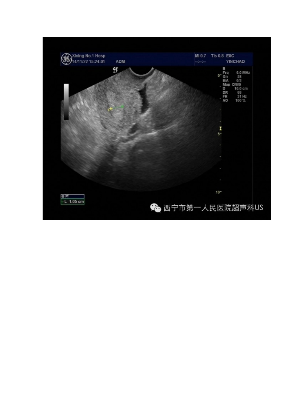 多囊卵巢综合征超声表现_第2页