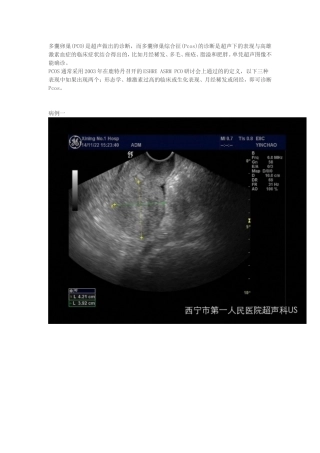多囊卵巢综合征超声表现