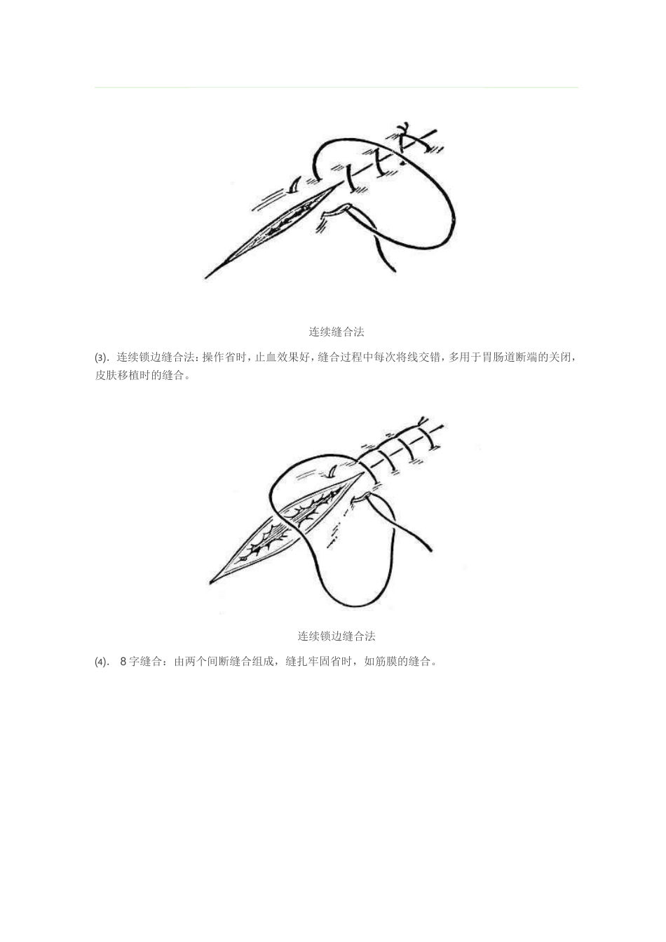 外科缝合手法图文讲解_第3页