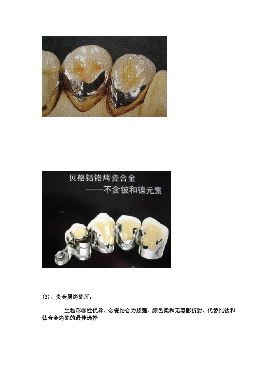 各种义齿的介绍_第3页