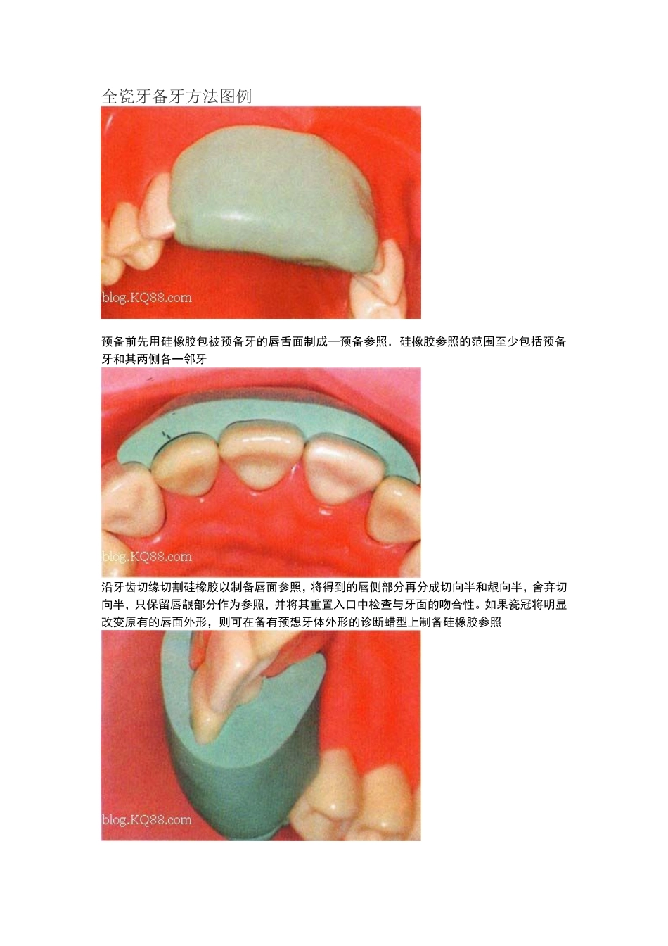 全瓷牙备牙方法图例(同名21832)_第1页