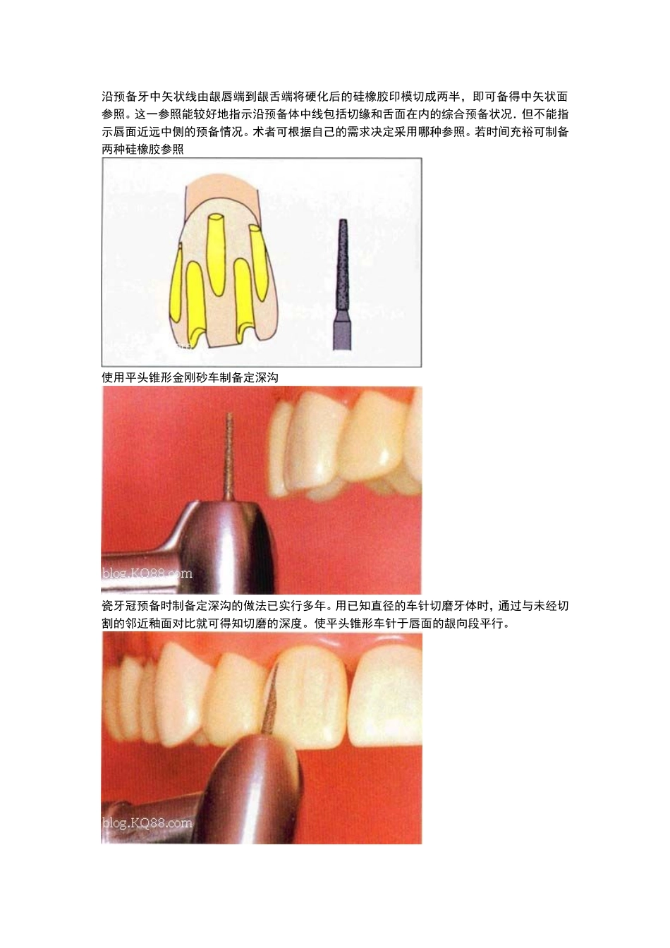 全瓷牙备牙方法图例(同名21832)_第2页