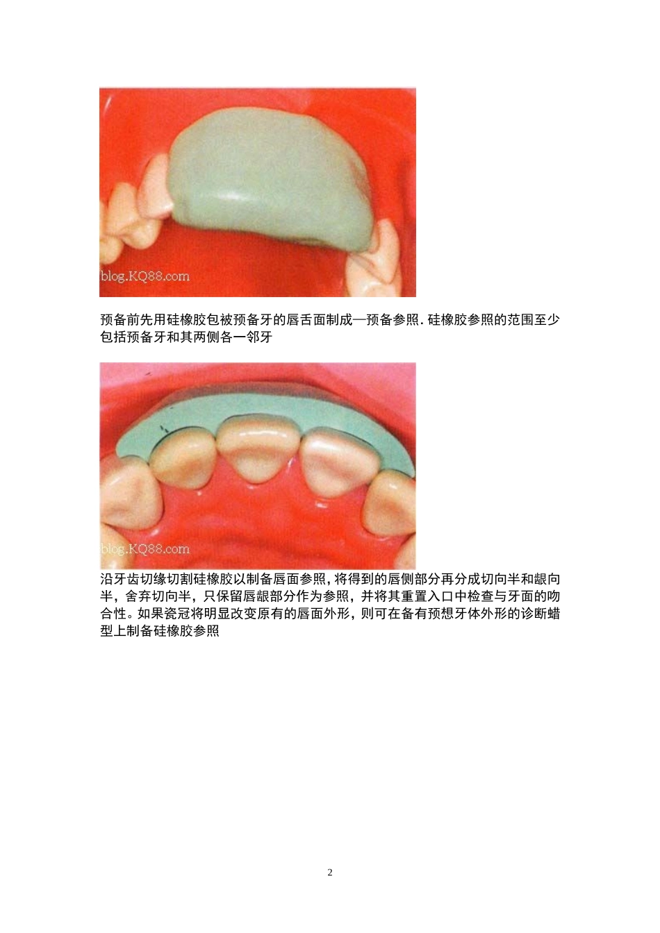 全瓷牙备牙方法图例_第2页