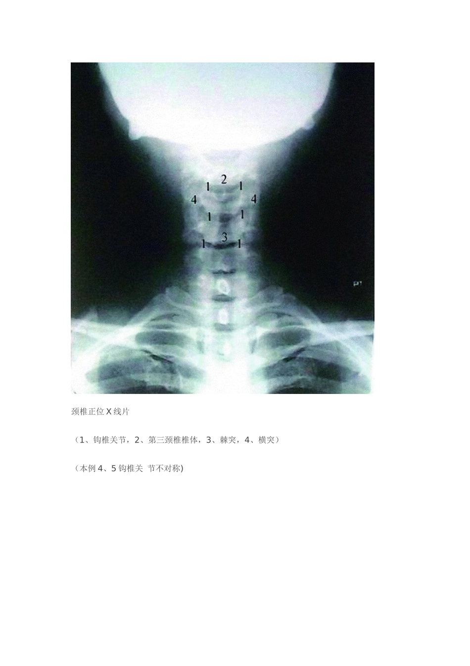 全脊柱影像学诊断_第1页