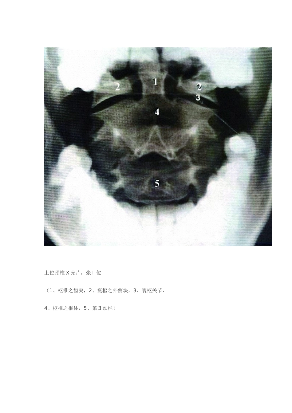 全脊柱影像学诊断_第3页