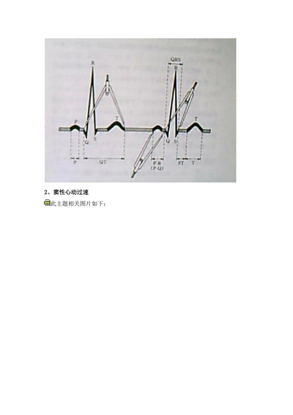 典型心电图讲解_第3页