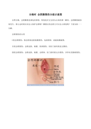 分娩时-会阴撕裂伤分级示意图