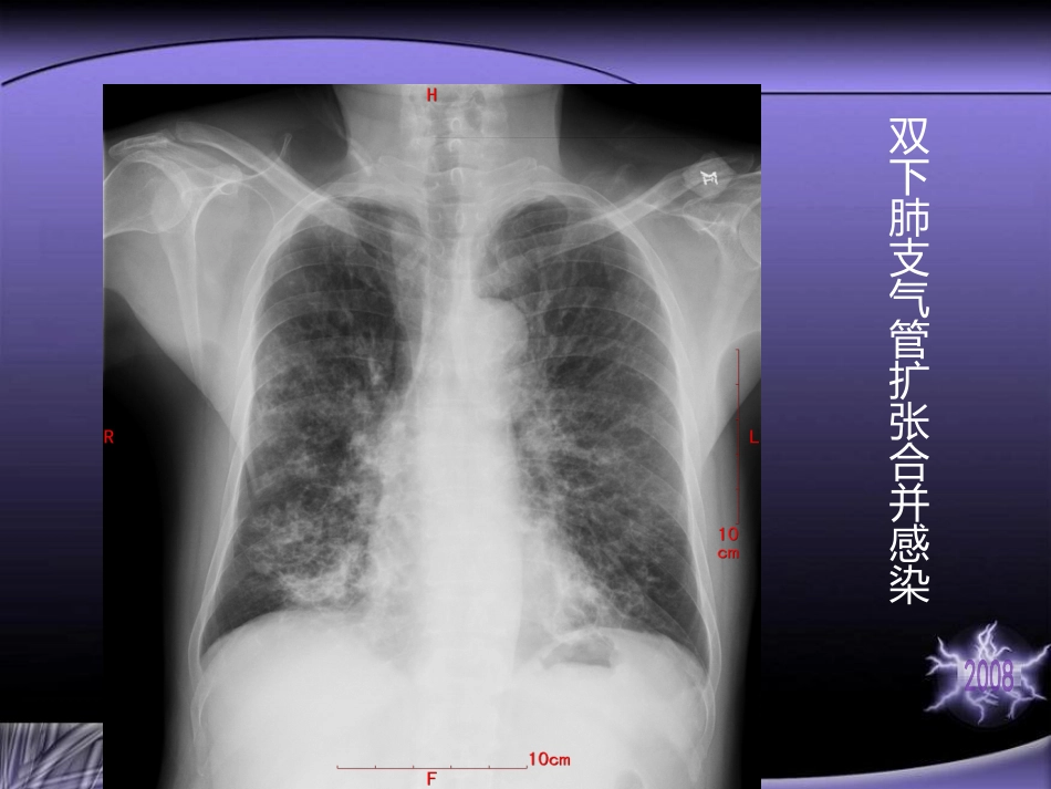 支气管扩张病因和病理学_第3页