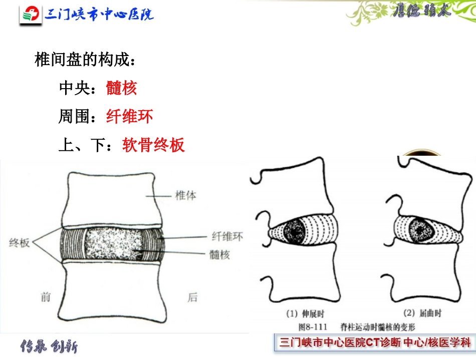 椎间盘膨出和突出_第2页
