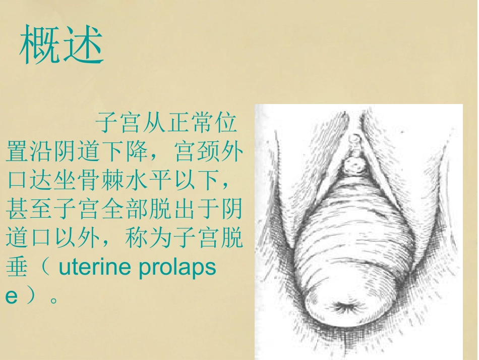 子宫脱垂小讲课_第3页