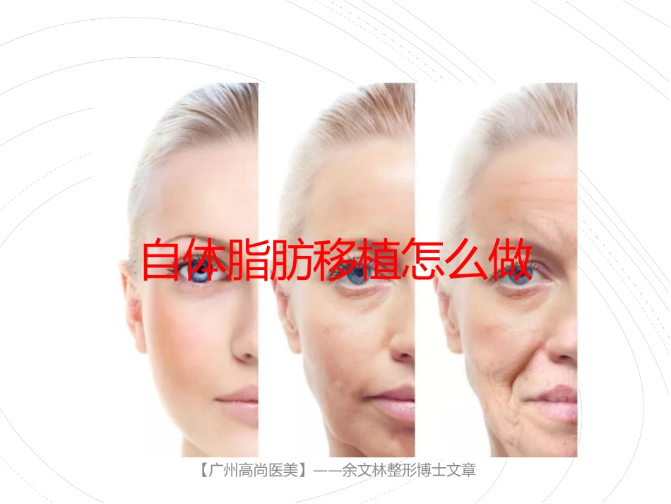 自体脂肪移植怎么做_第1页