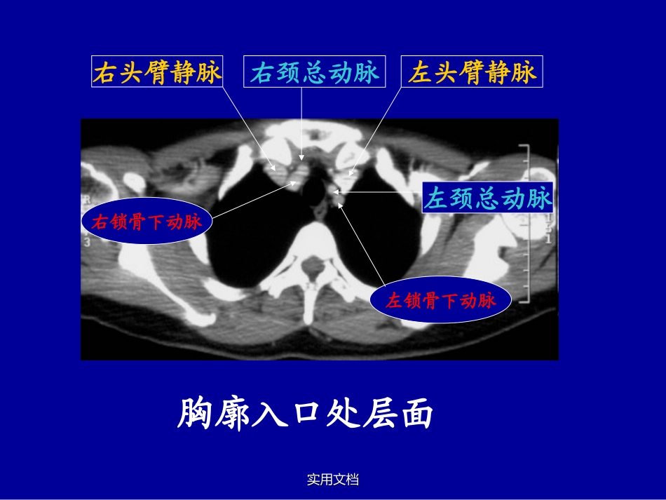 纵隔大血管CT表现_第2页