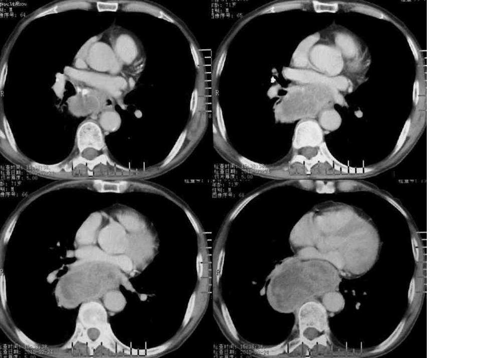 纵隔型肺癌综述_第3页